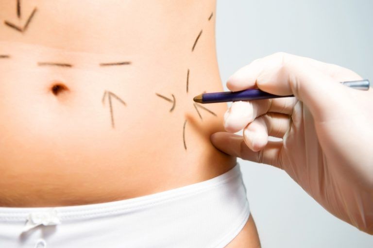 Todo lo que debes tener en cuenta antes de una liposucción